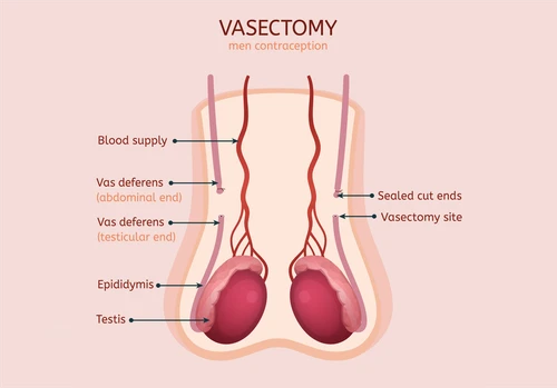 Vasectomy Expert North Miami FL