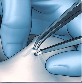 No-scalpel Vasectomy