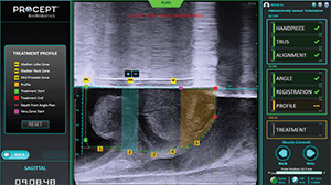 Procept BPH Imaging