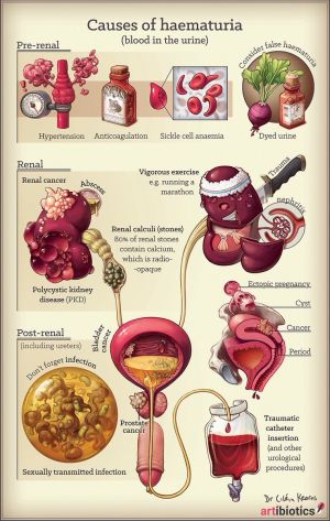 Hematuria