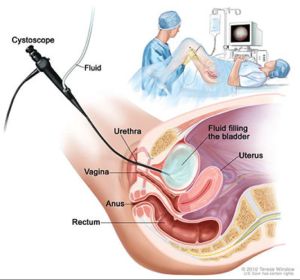 Cystoscopy Miami