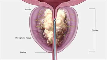 Enlarged Prostate Treatment Miami