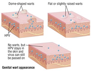 Appearance of Genital Warts