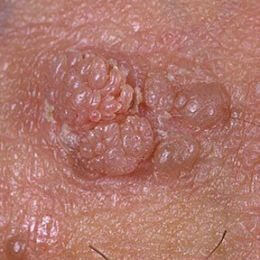 Warts genital for cure hpv How Human