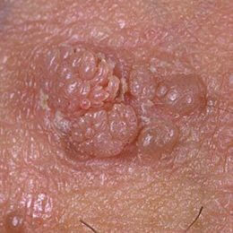 Treatment Anal Warts