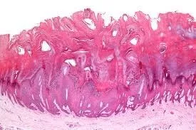Genital Warts