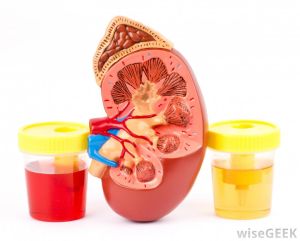 Hematuria