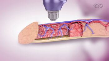 Low-Intensity Extracorporeal Shock Wave Therapy for ED