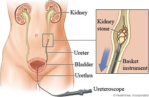 Kidney Stone  Expert Miami