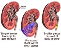 Treatment of Kidney Stones Miami and Fort Lauderdale