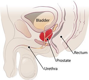 Robotic Prostate Surgery Clinic North Miami FL