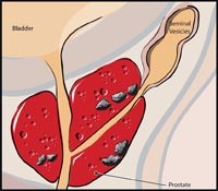 Robotic Prostate Surgery Clinic North Miami FL