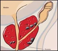 Robotic Prostate Surgery Clinic North Miami FL