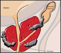 Robotic Prostate Surgery Clinic North Miami FL