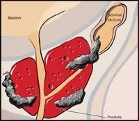 Robotic Prostate Surgery Clinic North Miami FL