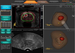 Targeted Prostate Biopsy Treatment Clinic Miami