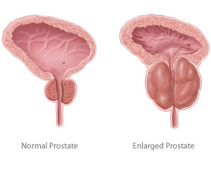 próstata normal vs agrandada