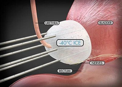 Prostate Cancer Cryotherapy Probes