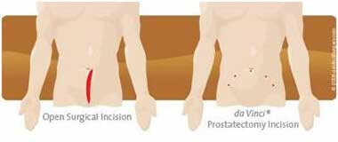 Traditional Prostatectomy Incision vs daVinci Prostatectomy Incision