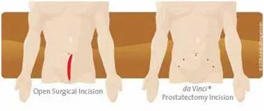 Traditional Prostatectomy Incision vs daVinci Prostatectomy Incision