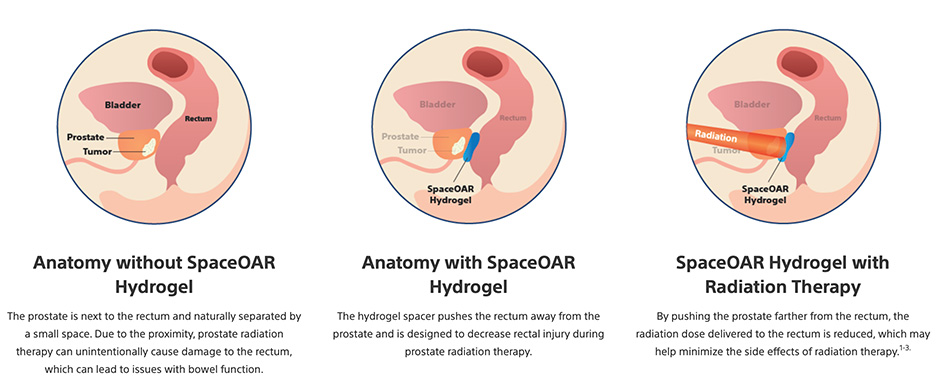 Space Oar for Radiation Therapy North Miami FL