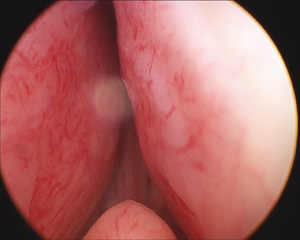 Terapia transuretral de microondas