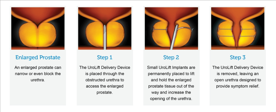 Urolift BPH Procedure Steps