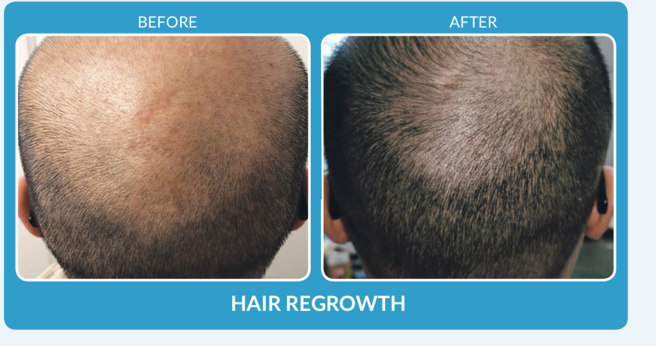 before and after hair restoration miami